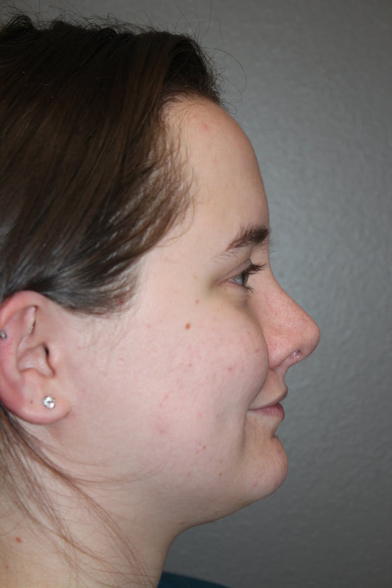 Rhinoplasty Before & After Gallery - Patient 141113621 - Image 2