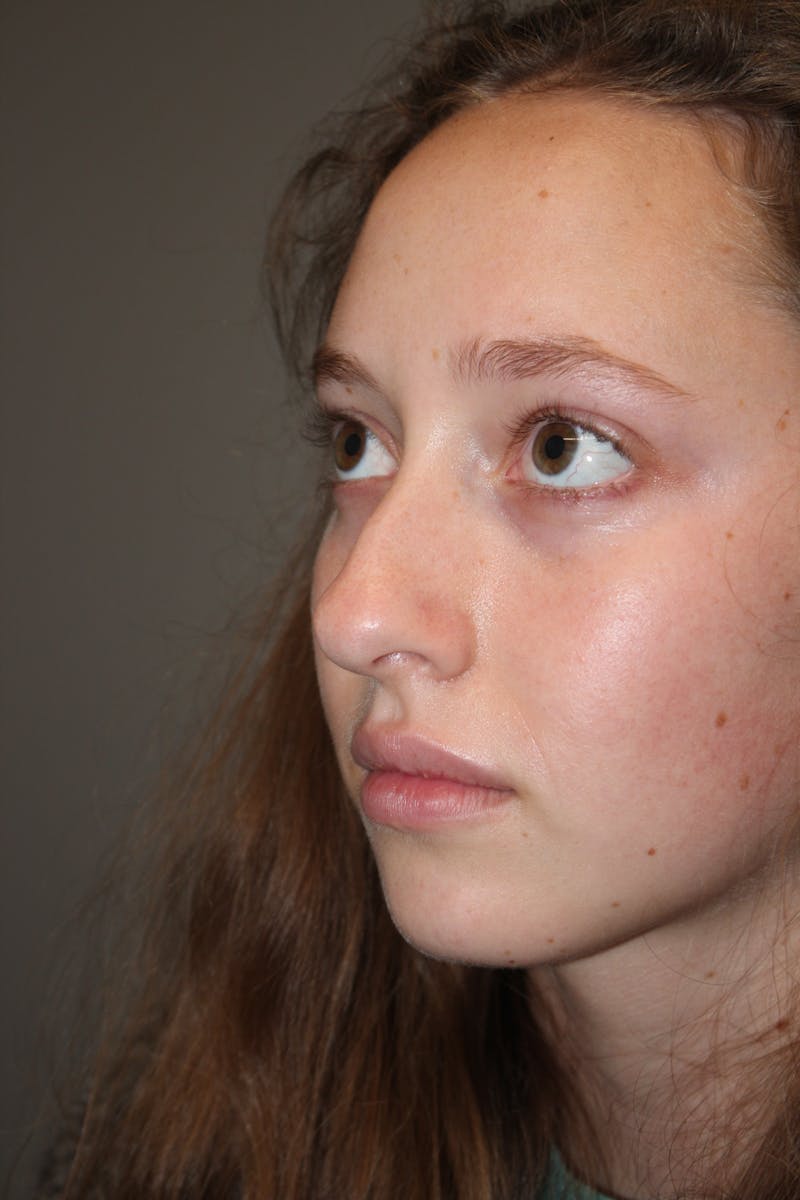 Rhinoplasty Before & After Gallery - Patient 141113617 - Image 7