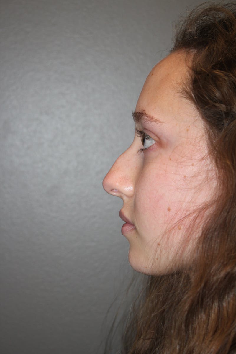 Rhinoplasty Before & After Gallery - Patient 141113617 - Image 5