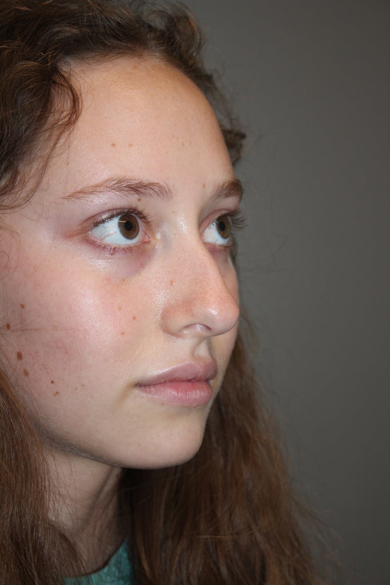 Rhinoplasty Before & After Gallery - Patient 141113617 - Image 3