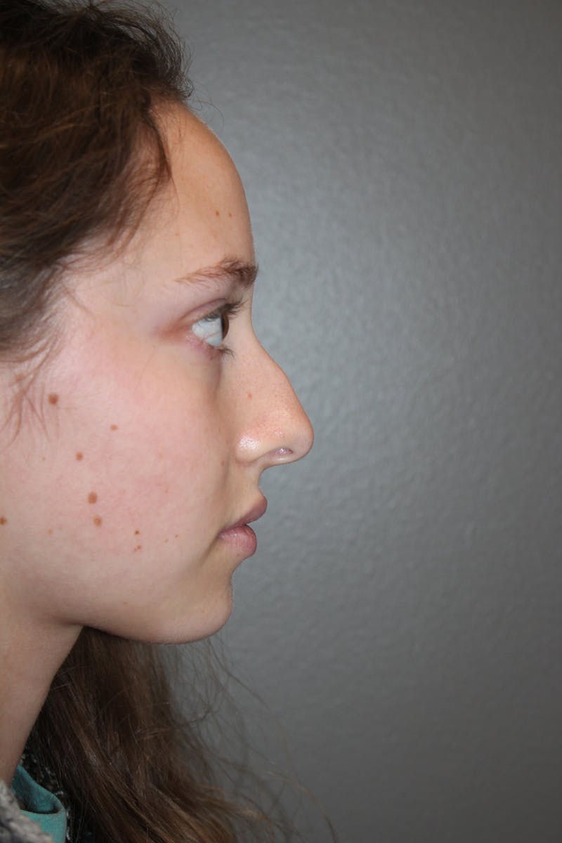 Rhinoplasty Before & After Gallery - Patient 141113617 - Image 1