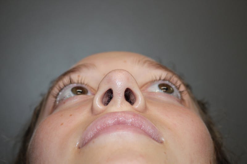 Rhinoplasty Before & After Gallery - Patient 141113617 - Image 12