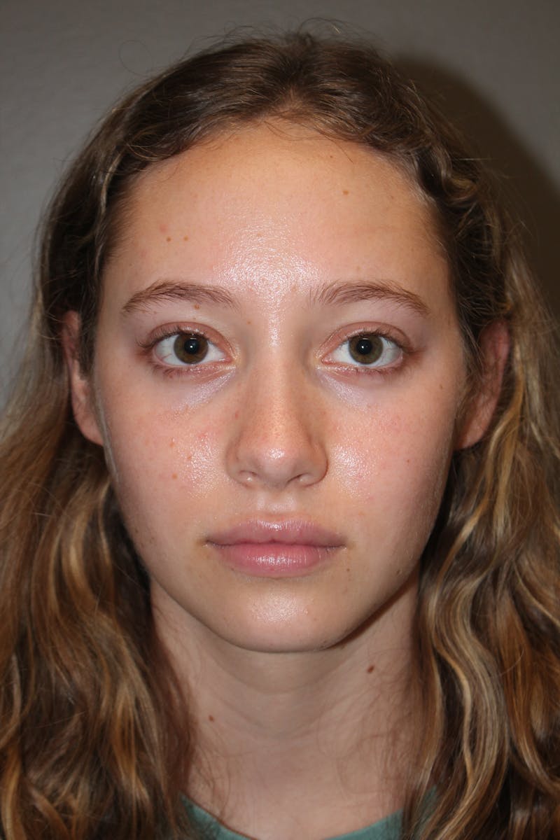 Rhinoplasty Before & After Gallery - Patient 141113617 - Image 10