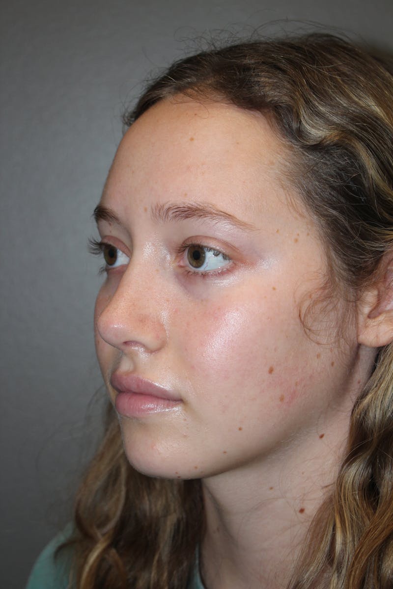Rhinoplasty Before & After Gallery - Patient 141113617 - Image 8