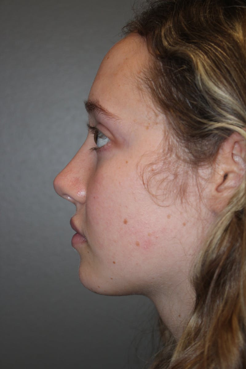 Rhinoplasty Before & After Gallery - Patient 141113617 - Image 6