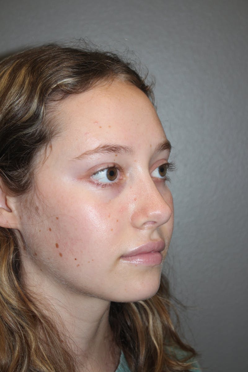 Rhinoplasty Before & After Gallery - Patient 141113617 - Image 4
