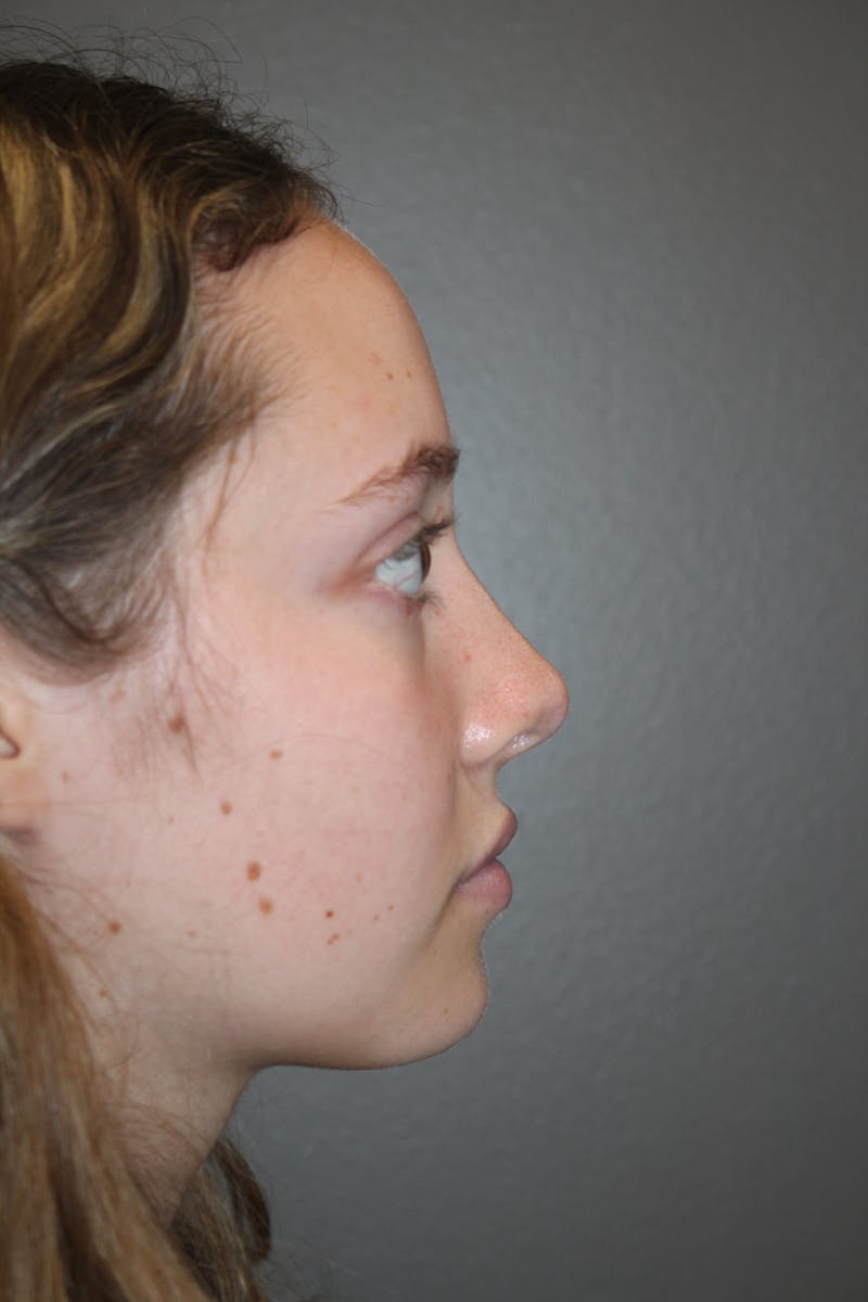 Rhinoplasty Before & After Gallery - Patient 141113617 - Image 2