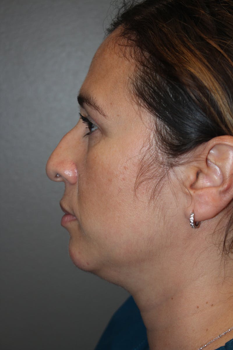 Rhinoplasty Before & After Gallery - Patient 141113615 - Image 7