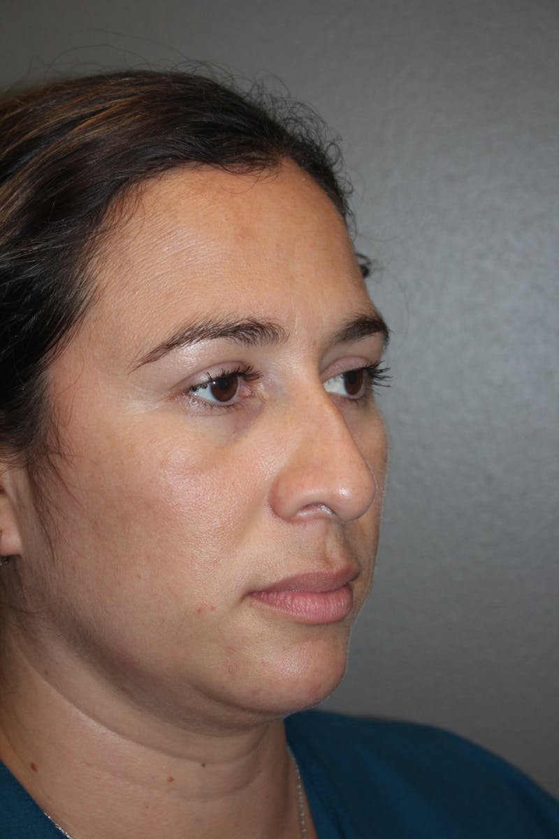 Rhinoplasty Before & After Gallery - Patient 141113615 - Image 3