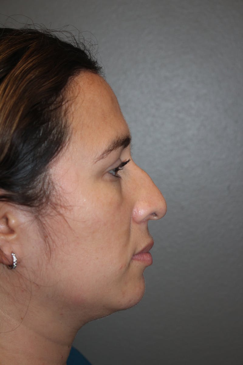 Rhinoplasty Before & After Gallery - Patient 141113615 - Image 1