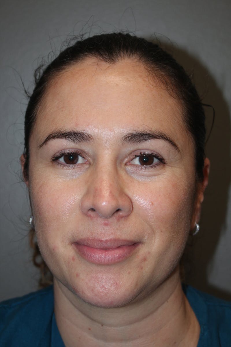 Rhinoplasty Before & After Gallery - Patient 141113615 - Image 10