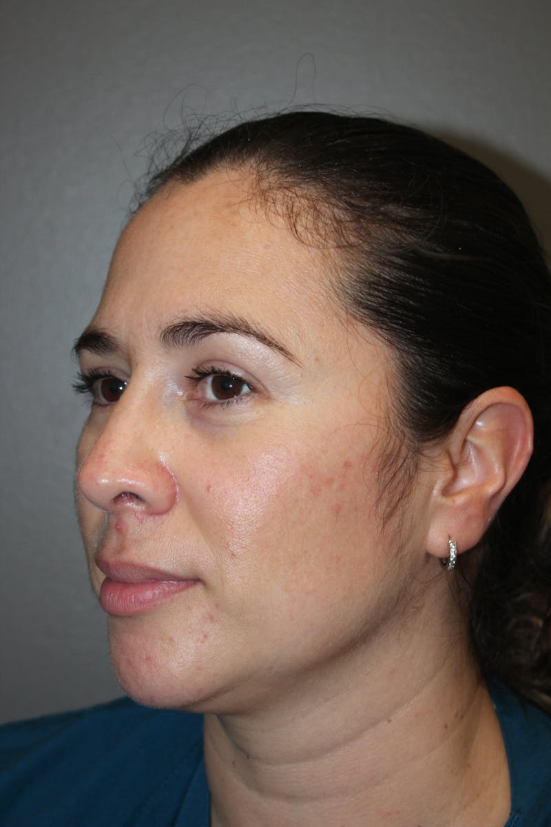 Rhinoplasty Before & After Gallery - Patient 141113615 - Image 6