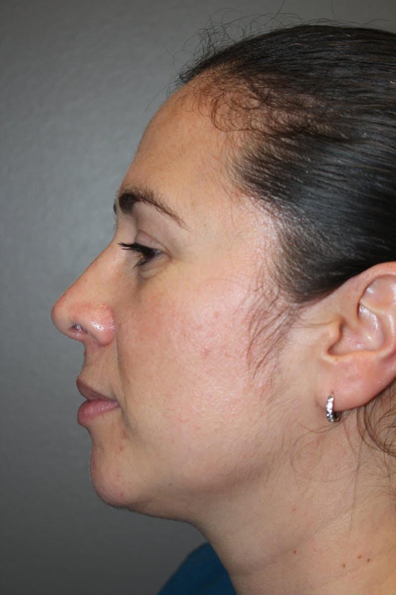 Rhinoplasty Before & After Gallery - Patient 141113615 - Image 8