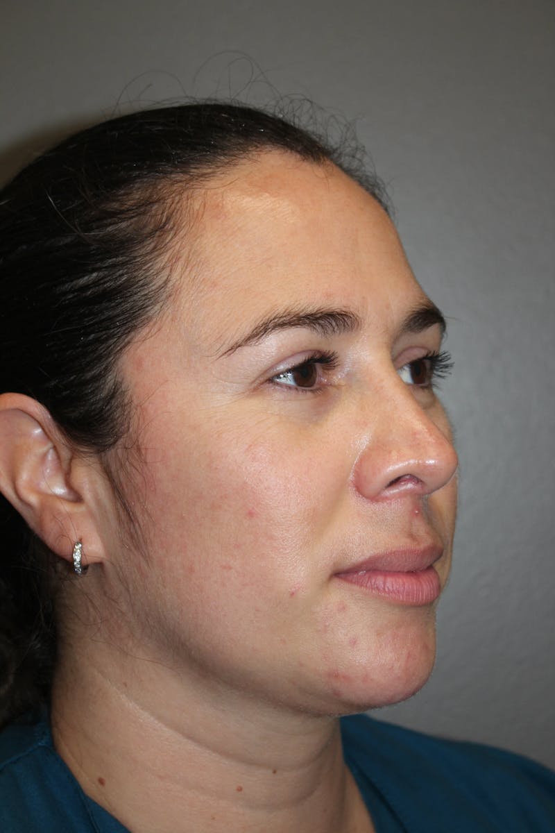 Rhinoplasty Before & After Gallery - Patient 141113615 - Image 4
