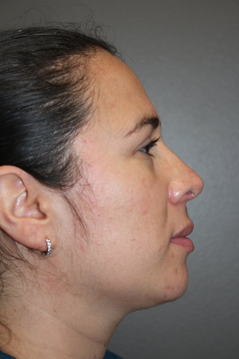 Rhinoplasty Before & After Gallery - Patient 141113615 - Image 2