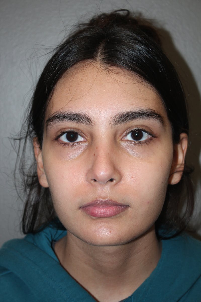 Rhinoplasty Before & After Gallery - Patient 141113614 - Image 10