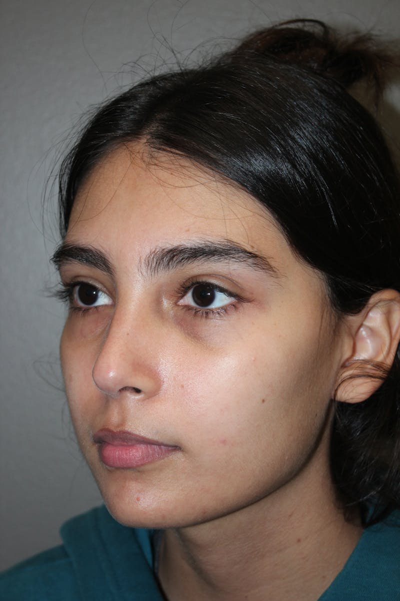 Rhinoplasty Before & After Gallery - Patient 141113614 - Image 8