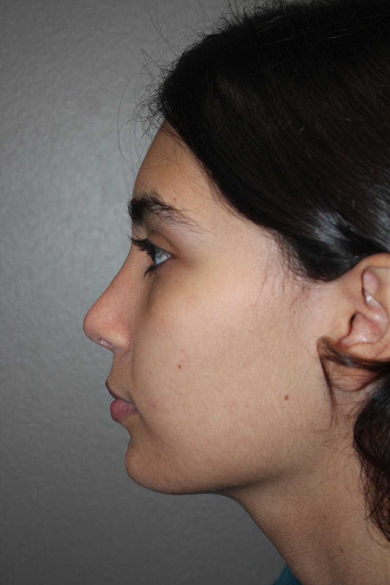Rhinoplasty Before & After Gallery - Patient 141113614 - Image 6