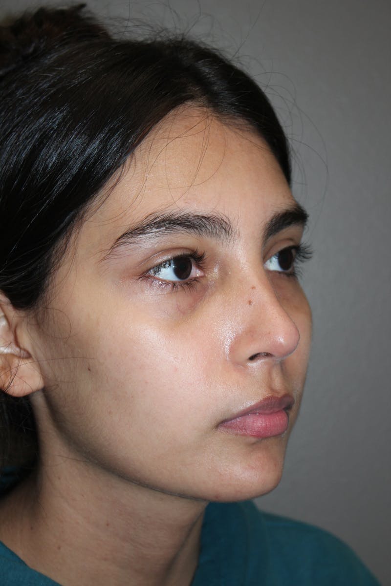 Rhinoplasty Before & After Gallery - Patient 141113614 - Image 4