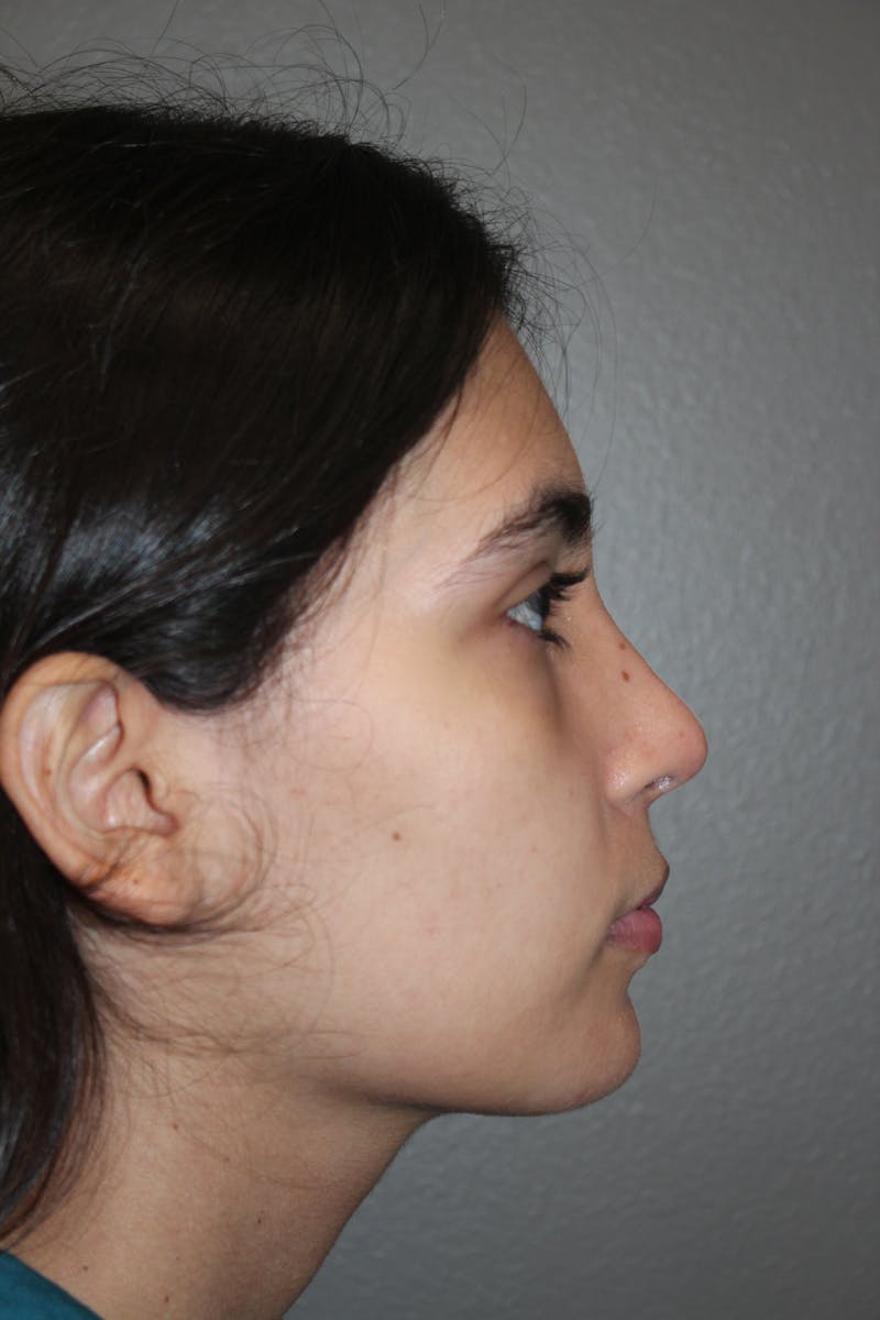 Rhinoplasty Before & After Gallery - Patient 141113614 - Image 2