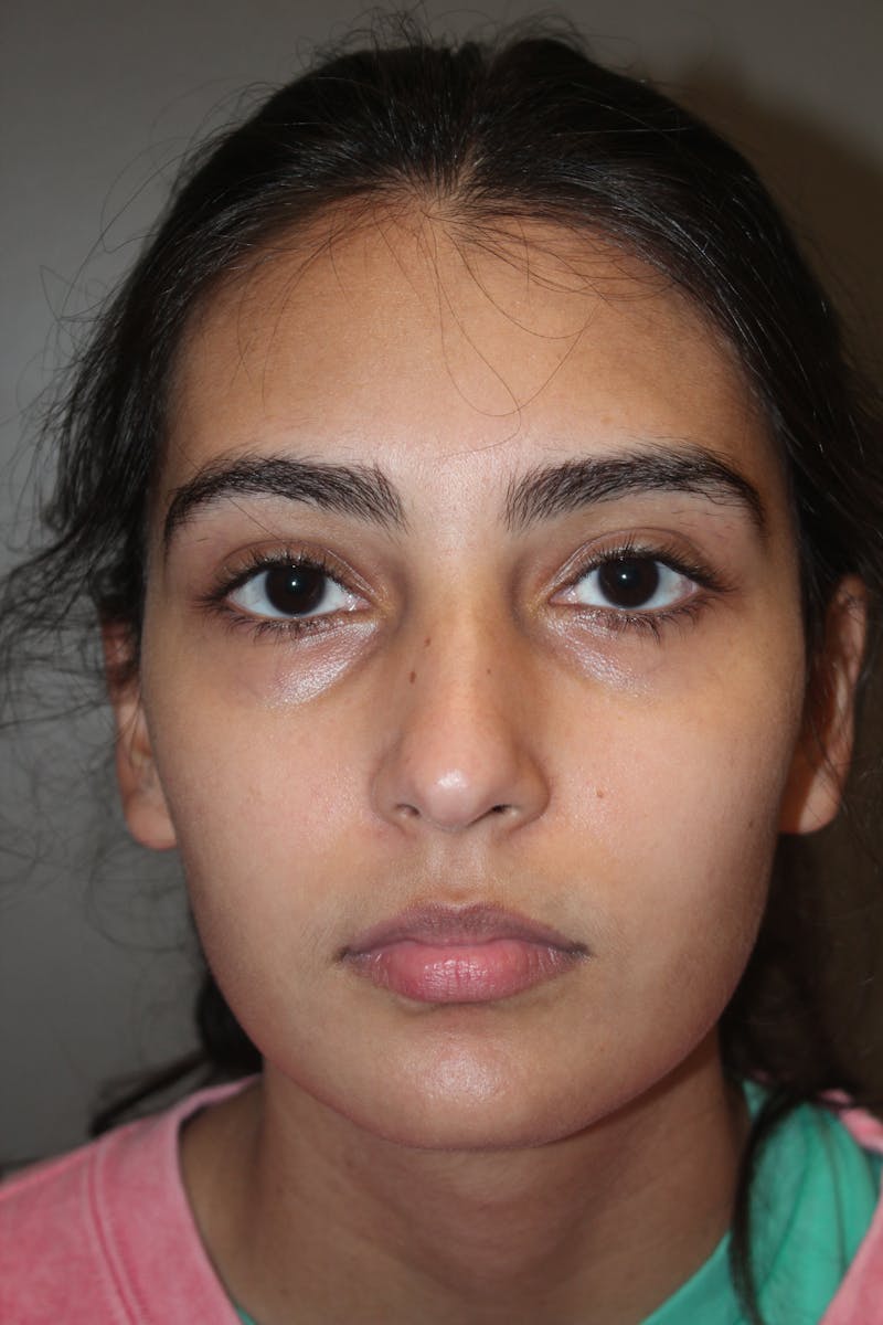 Rhinoplasty Before & After Gallery - Patient 141113614 - Image 9