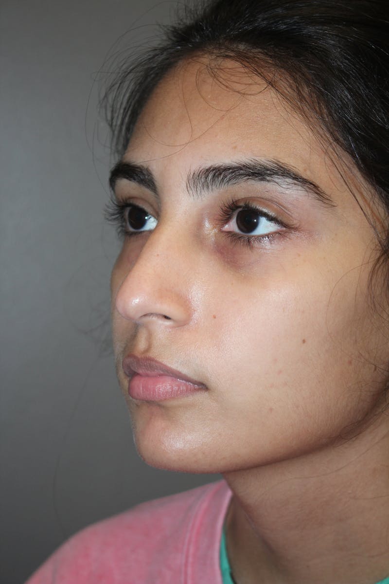 Rhinoplasty Before & After Gallery - Patient 141113614 - Image 7