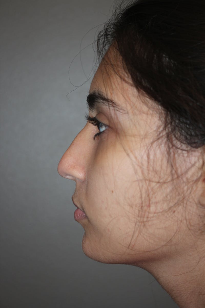 Rhinoplasty Before & After Gallery - Patient 141113614 - Image 5