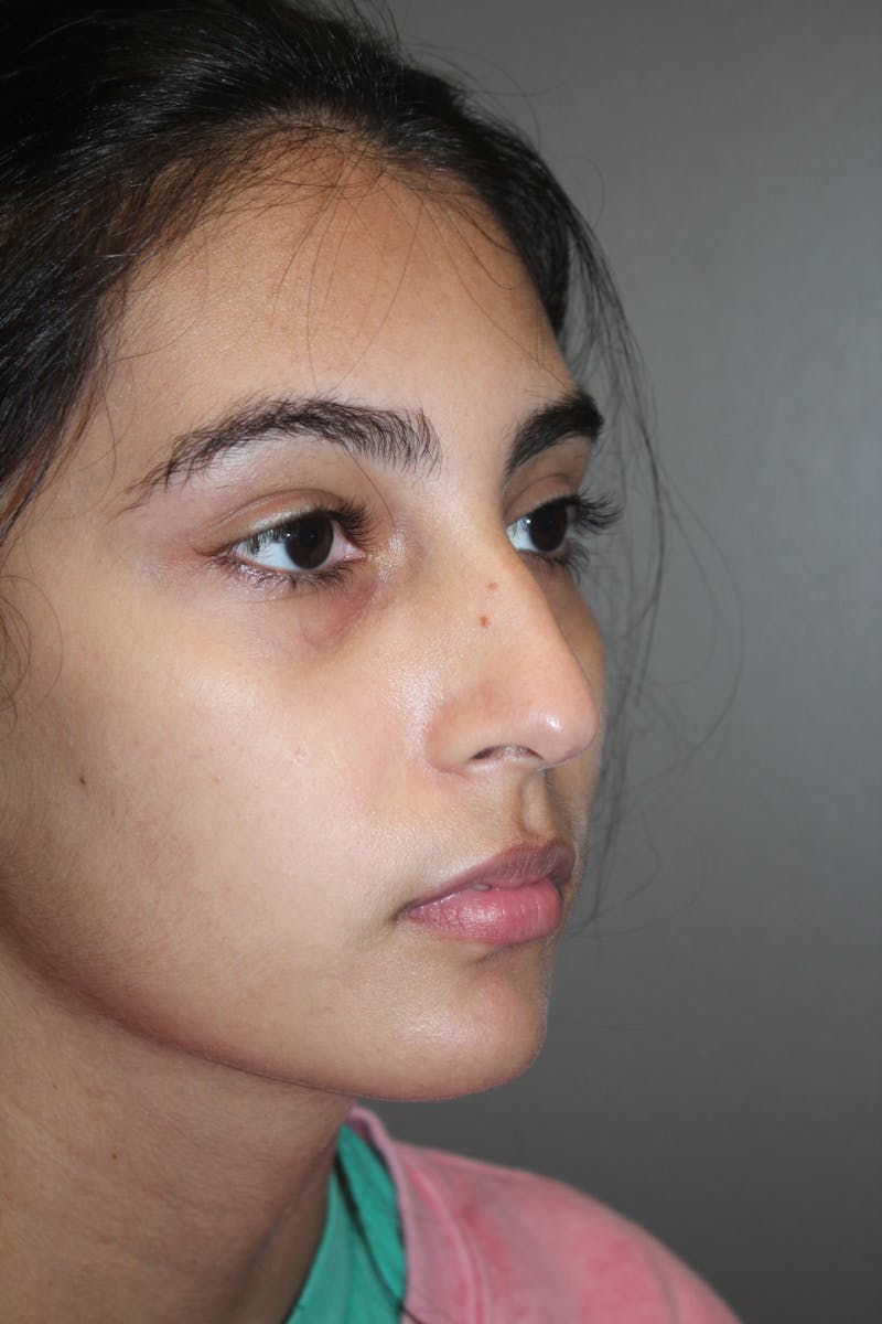 Rhinoplasty Before & After Gallery - Patient 141113614 - Image 3