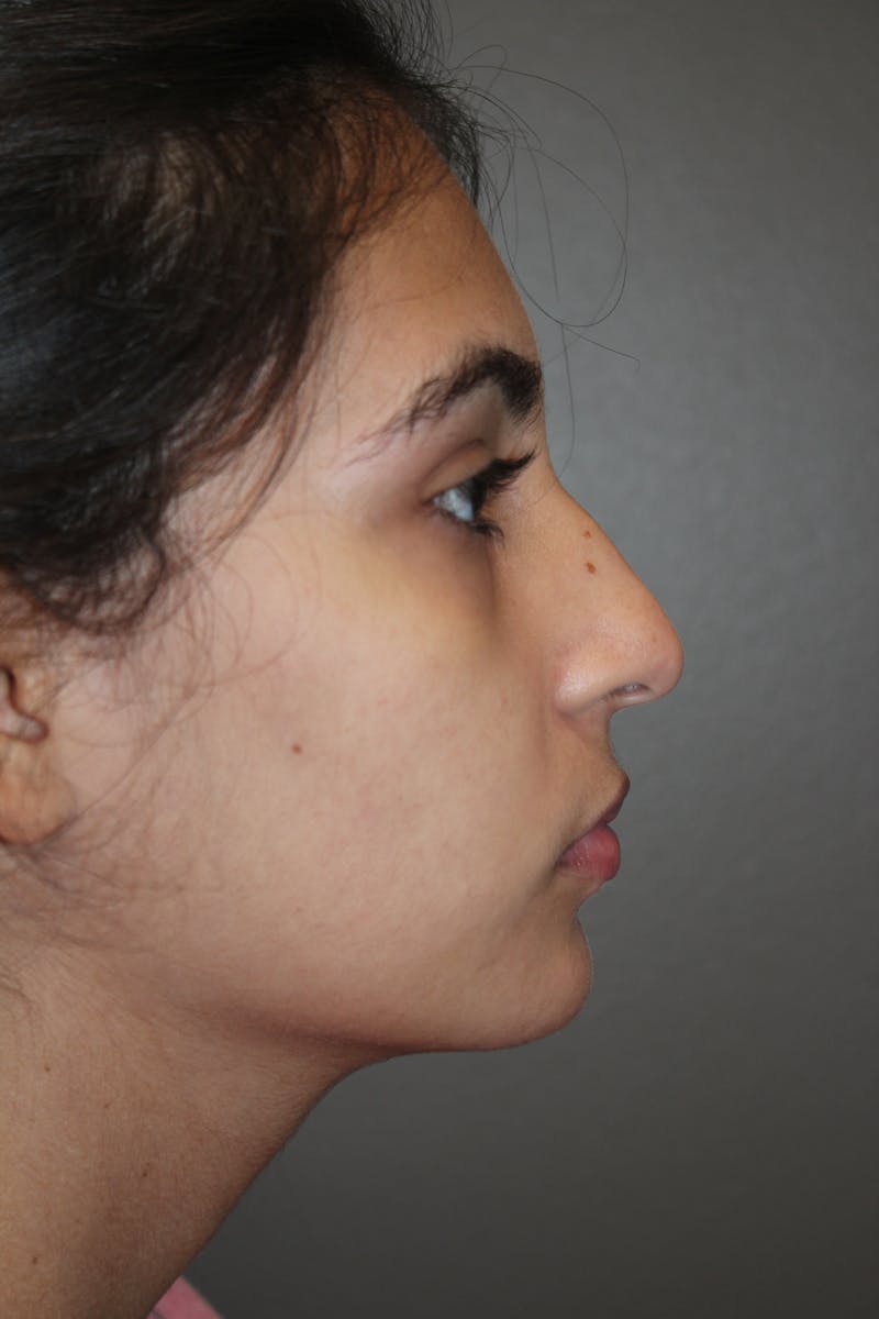 Rhinoplasty Before & After Gallery - Patient 141113614 - Image 1
