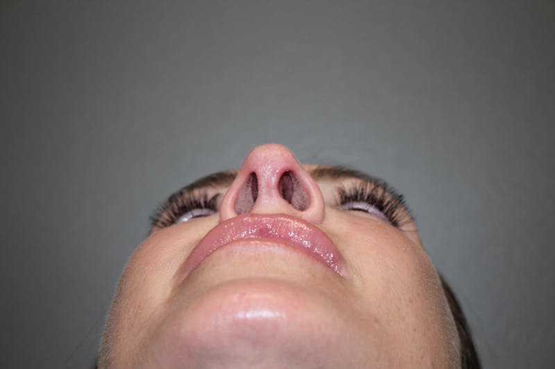 Rhinoplasty Before & After Gallery - Patient 141113607 - Image 12