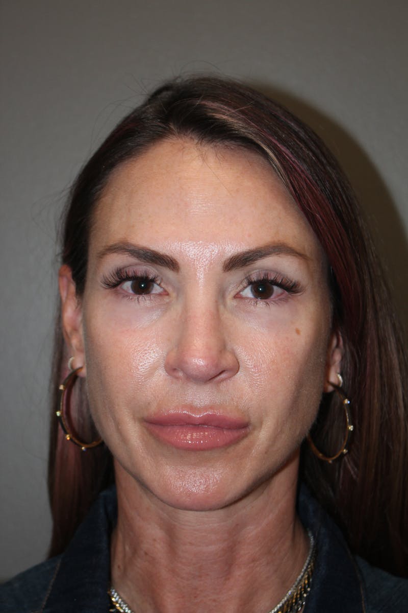Rhinoplasty Before & After Gallery - Patient 141113607 - Image 10