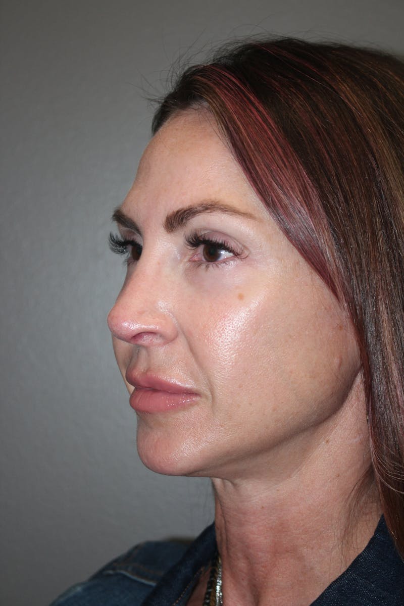 Rhinoplasty Before & After Gallery - Patient 141113607 - Image 8