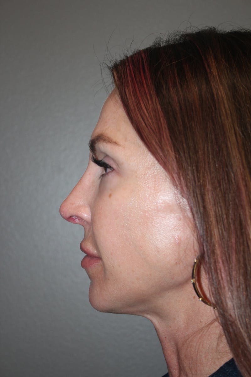 Rhinoplasty Before & After Gallery - Patient 141113607 - Image 6