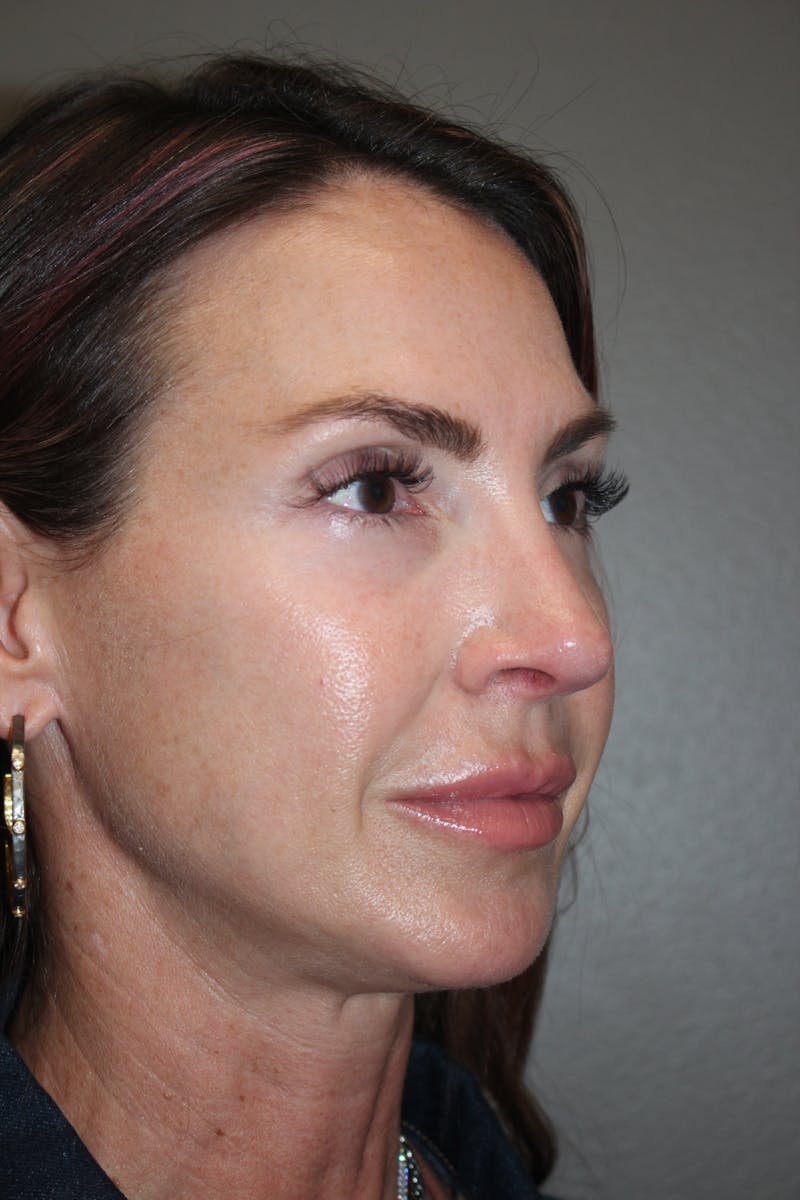 Rhinoplasty Before & After Gallery - Patient 141113607 - Image 4