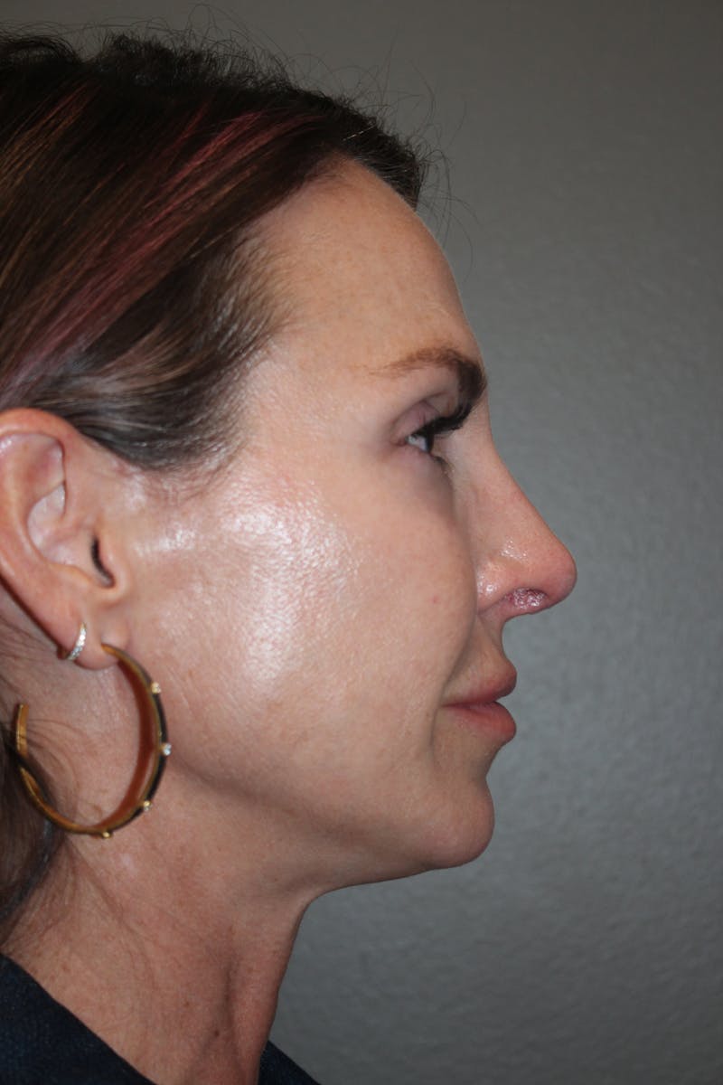 Rhinoplasty Before & After Gallery - Patient 141113607 - Image 2
