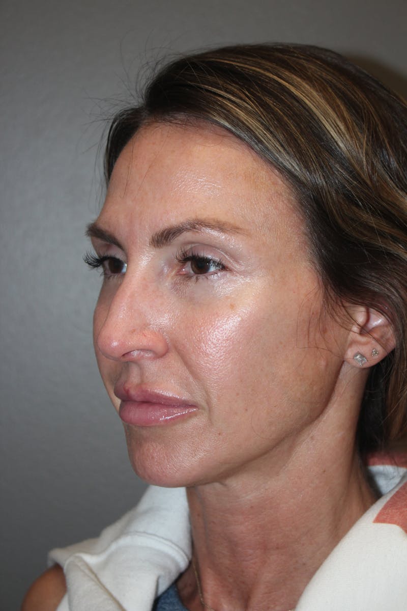 Rhinoplasty Before & After Gallery - Patient 141113607 - Image 7