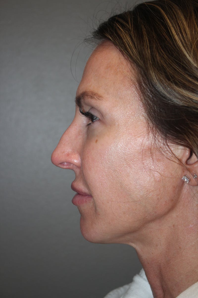 Rhinoplasty Before & After Gallery - Patient 141113607 - Image 5