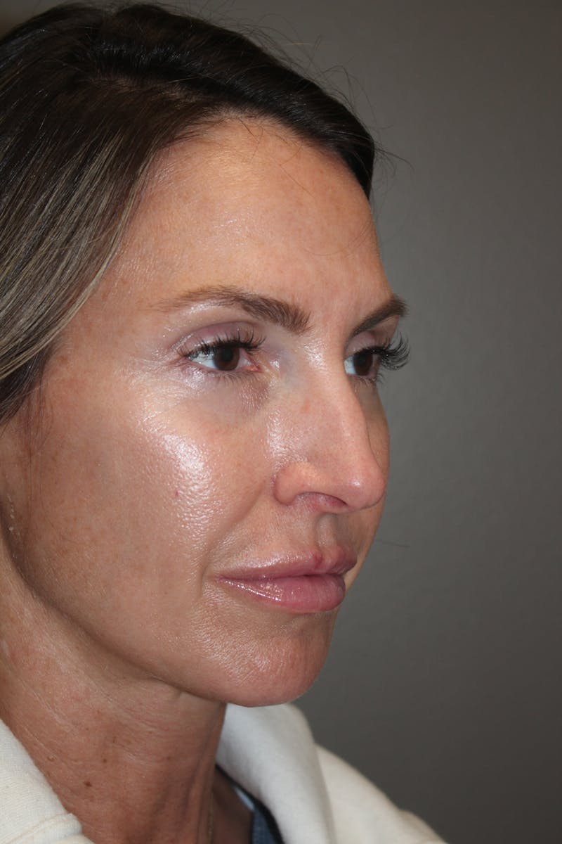 Rhinoplasty Before & After Gallery - Patient 141113607 - Image 3