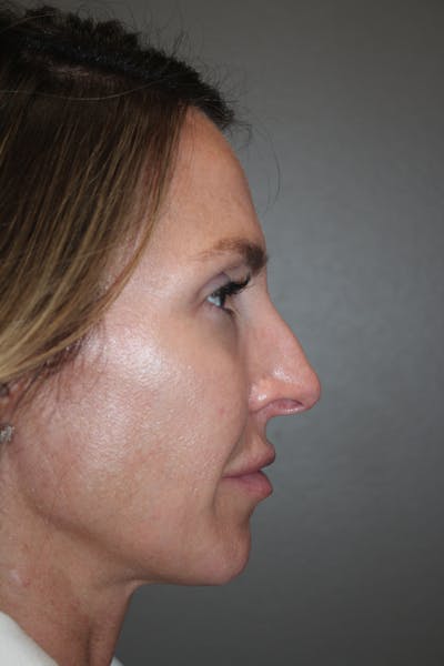 Rhinoplasty Before & After Gallery - Patient 141113607 - Image 1