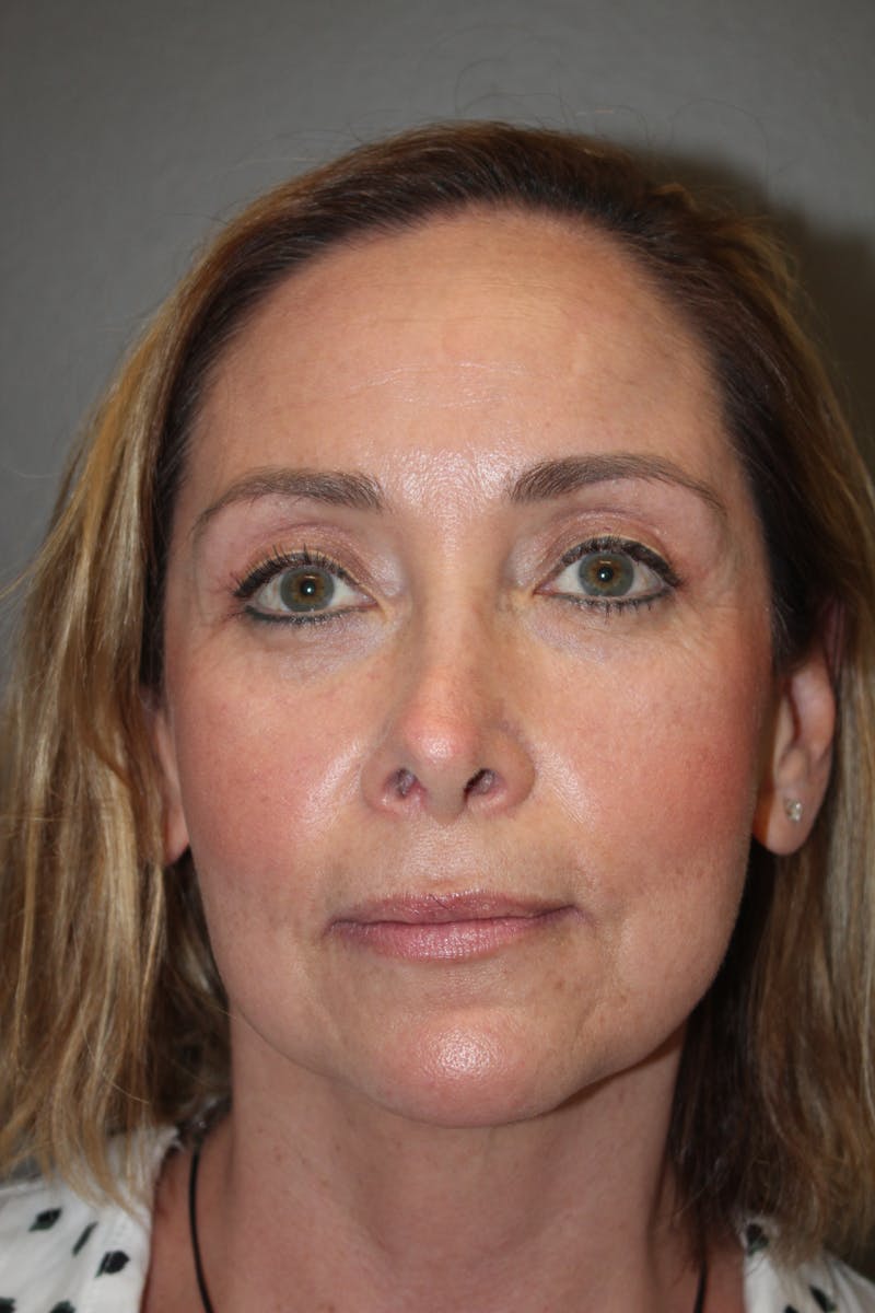 Eyelid surgery Before & After Gallery - Patient 141113668 - Image 2