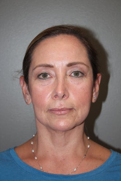 Eyelid surgery Before & After Gallery - Patient 141113668 - Image 1