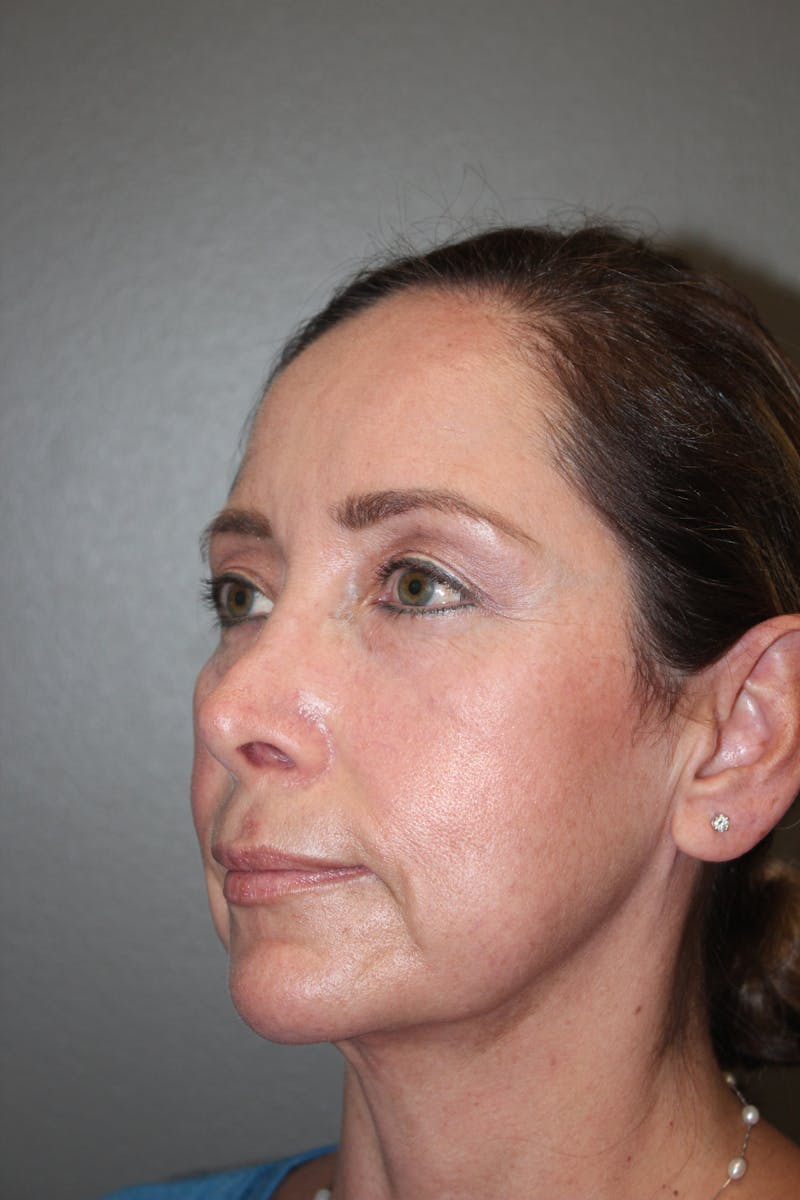 Eyelid surgery Before & After Gallery - Patient 141113668 - Image 3