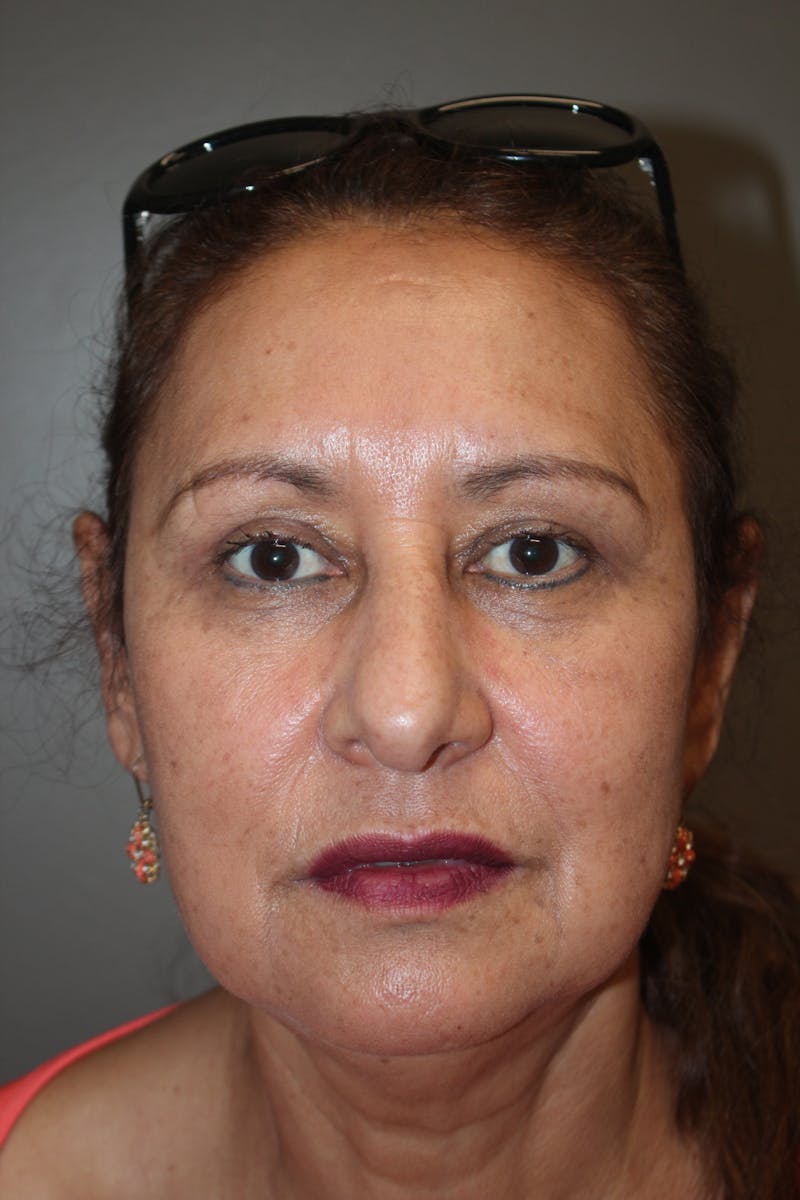 Eyelid surgery Before & After Gallery - Patient 141113671 - Image 2
