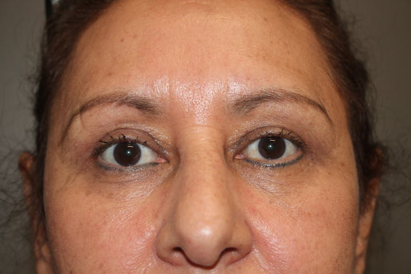Eyelid surgery Gallery - Patient 141113671 - Image 4
