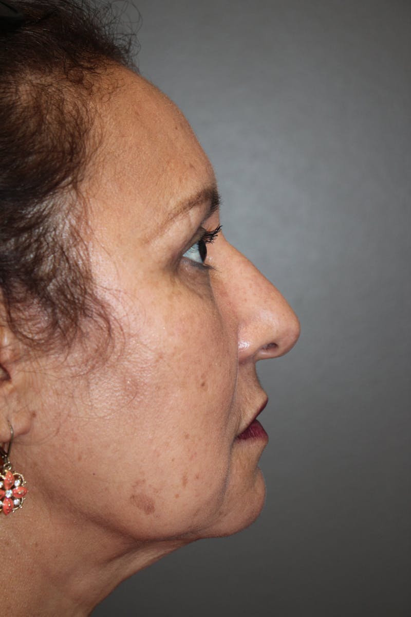 Eyelid surgery Before & After Gallery - Patient 141113671 - Image 6