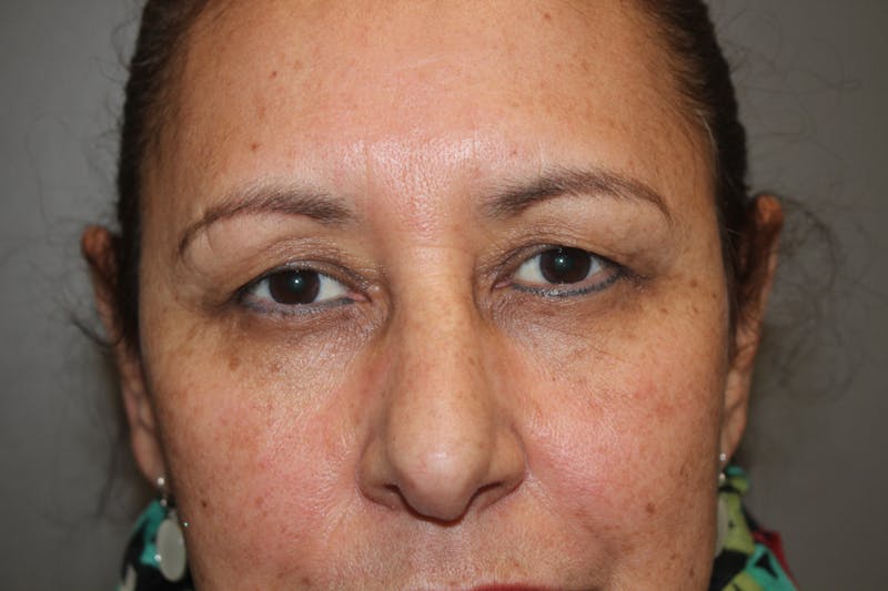 Eyelid surgery Gallery - Patient 141113671 - Image 3