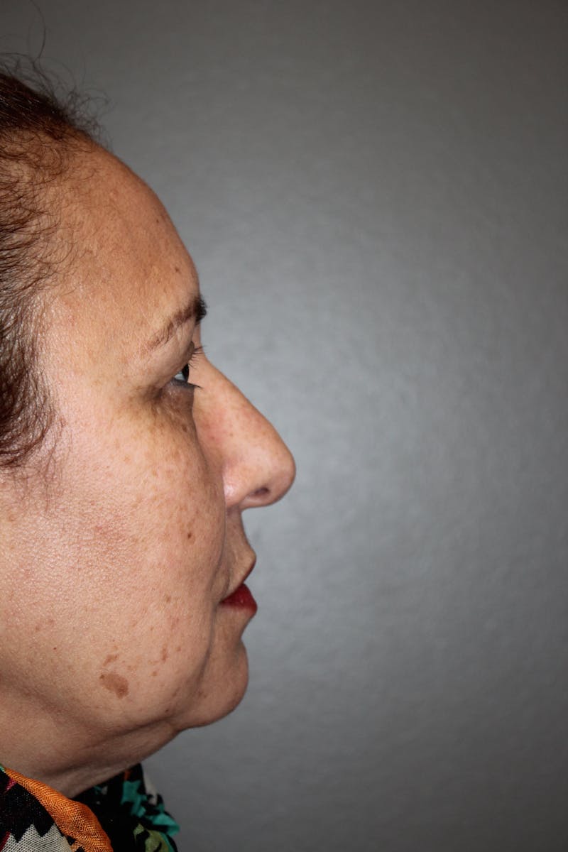 Eyelid surgery Before & After Gallery - Patient 141113671 - Image 5