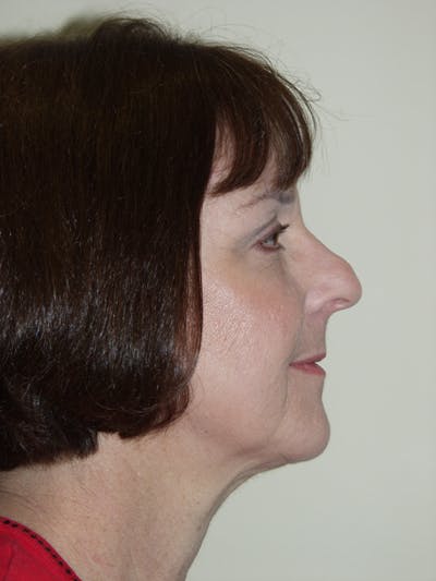 Rhinoplasty Before & After Gallery - Patient 52507132 - Image 1
