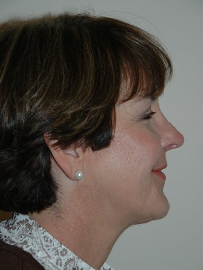 Rhinoplasty Before & After Gallery - Patient 52507132 - Image 2