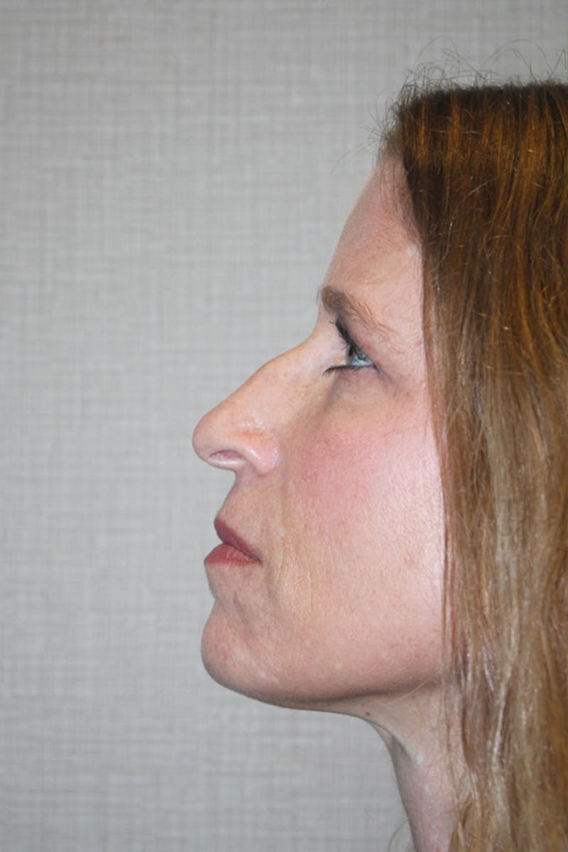 Chemical Peel Before & After Gallery - Patient 146669152 - Image 5